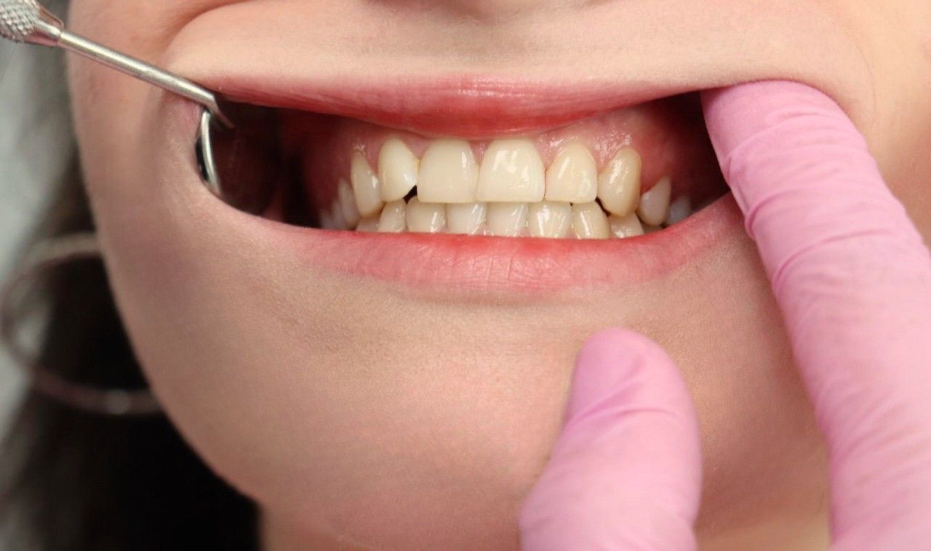 Ein Zahnarzt untersucht die Zähne einer Person. Der Mund ist geöffnet, Zahnfleisch und Zähne sind sichtbar. Eine rosa behandschuhte Hand zieht an der Wange. Ein Zahnspiegel ist vorhanden.