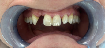 Vorher Nachher Veneers