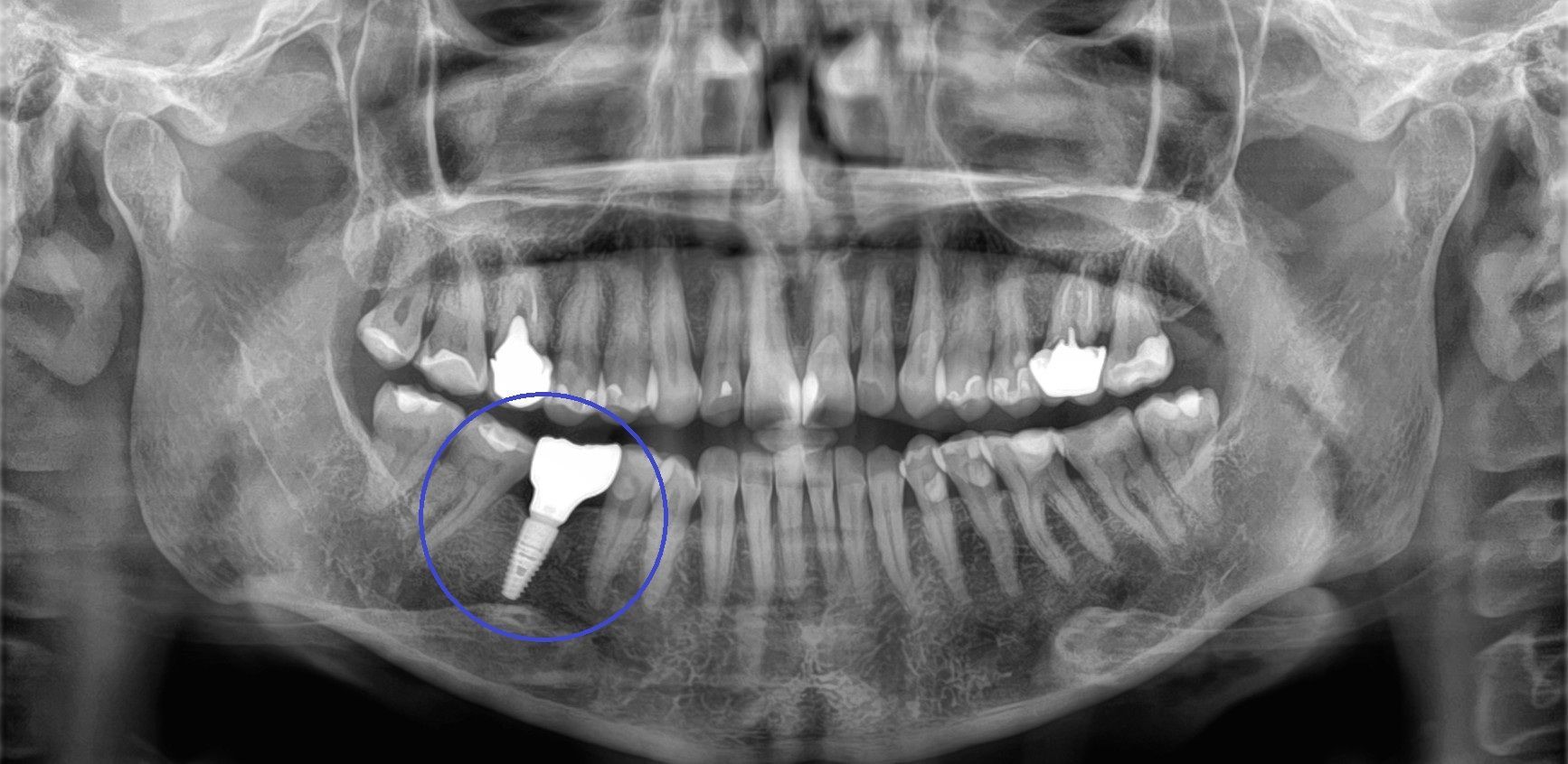Implantat Röntgen