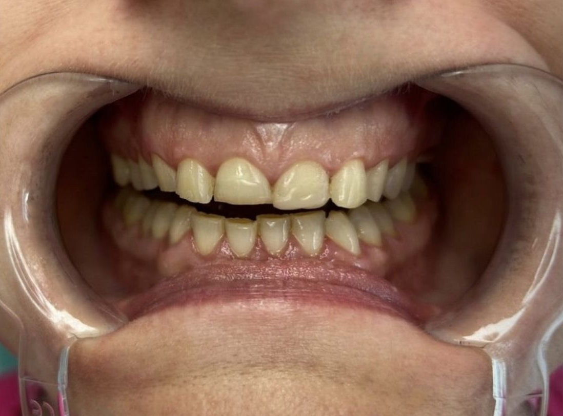 Vorher Nachher Veneers