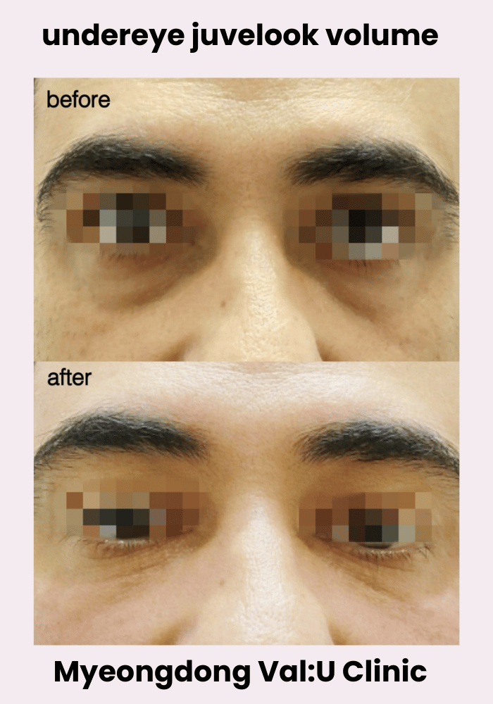 Before and after Under-eye Juvelook Volume at Val:U Clinic Myeongdong