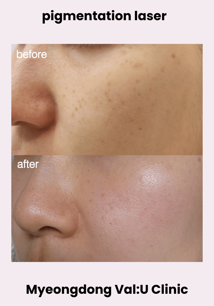 Before and after Pigmentation laser at Val:U Clinic Myeongdong
