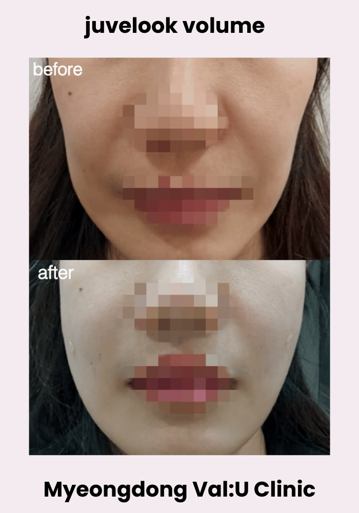 Before and after Juvelook Volume at Val:U Clinic Myeongdong