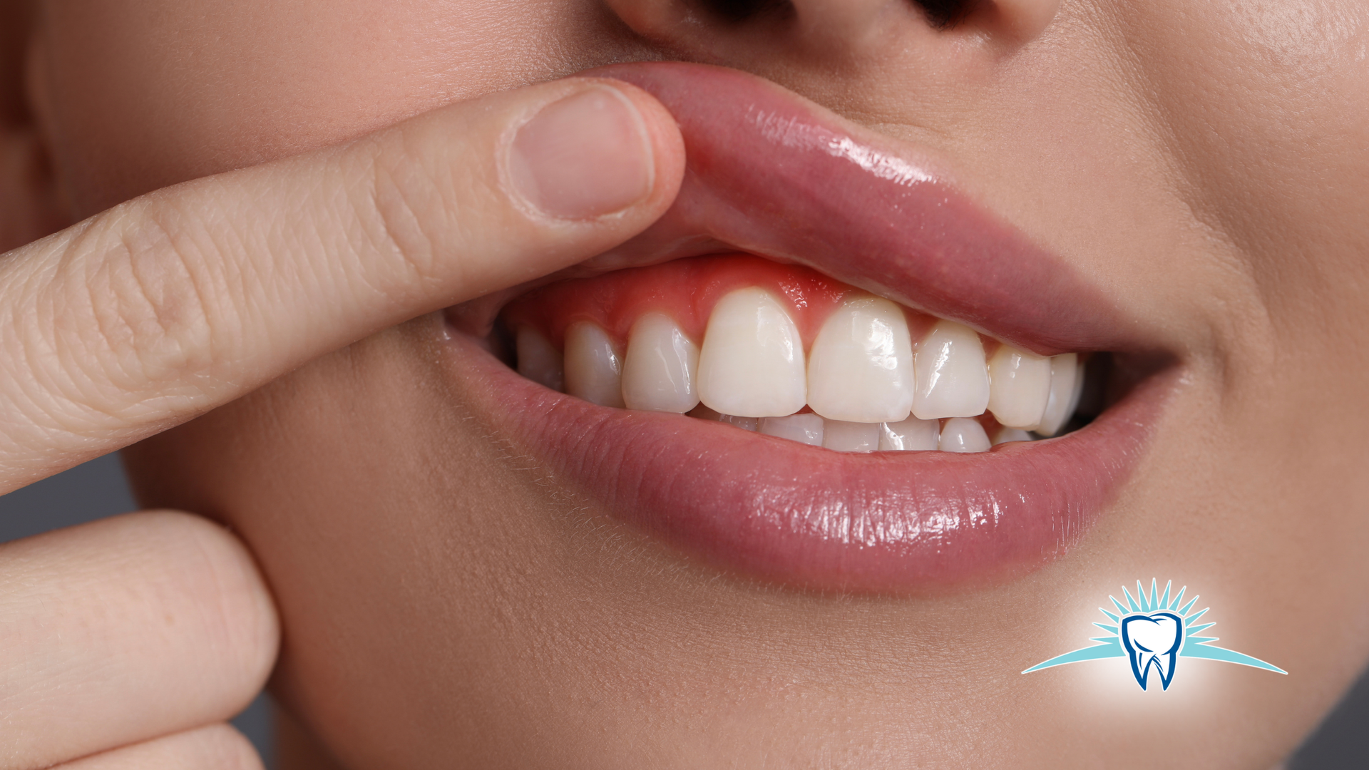 Close-up of a person's mouth, showing inflamed, red gums. Finger is pointing at the gums, near white teeth.