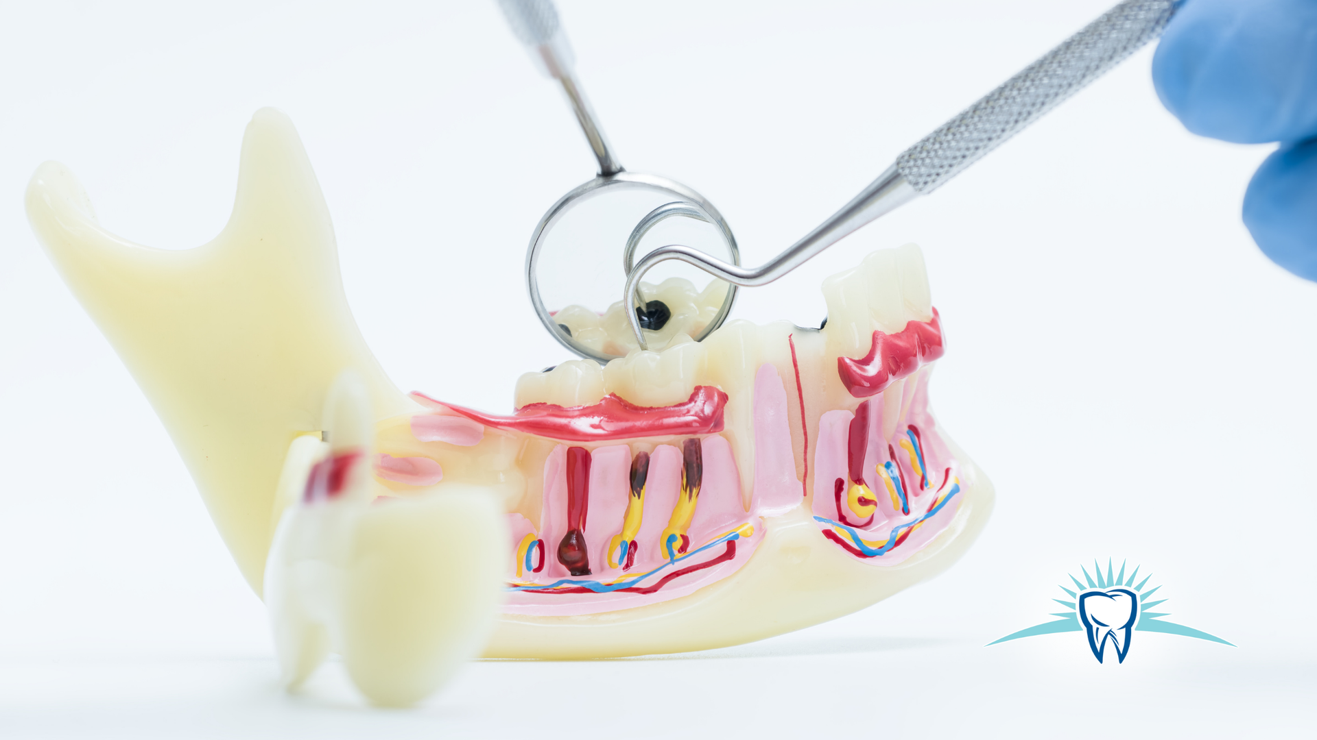Dentist tools examining a model of teeth and gums, showing a cavity.