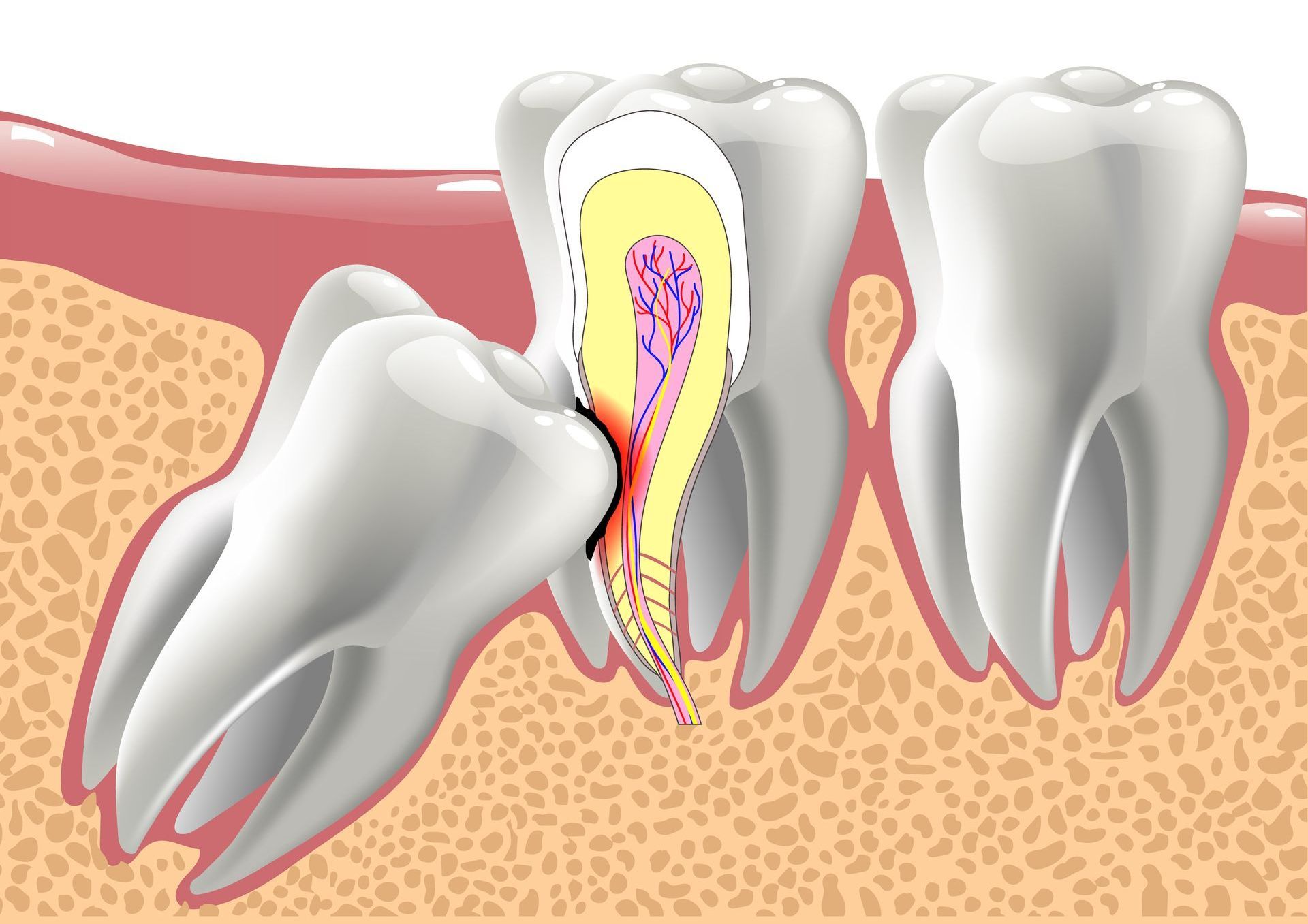 A diagram of a tooth with a hole in it.
