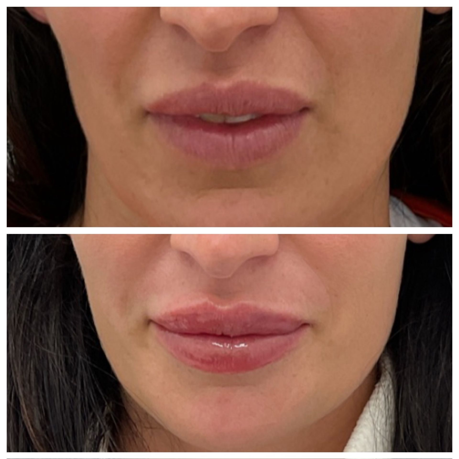 Lower lip lines Botox in South Windsor | IV Lounge CT