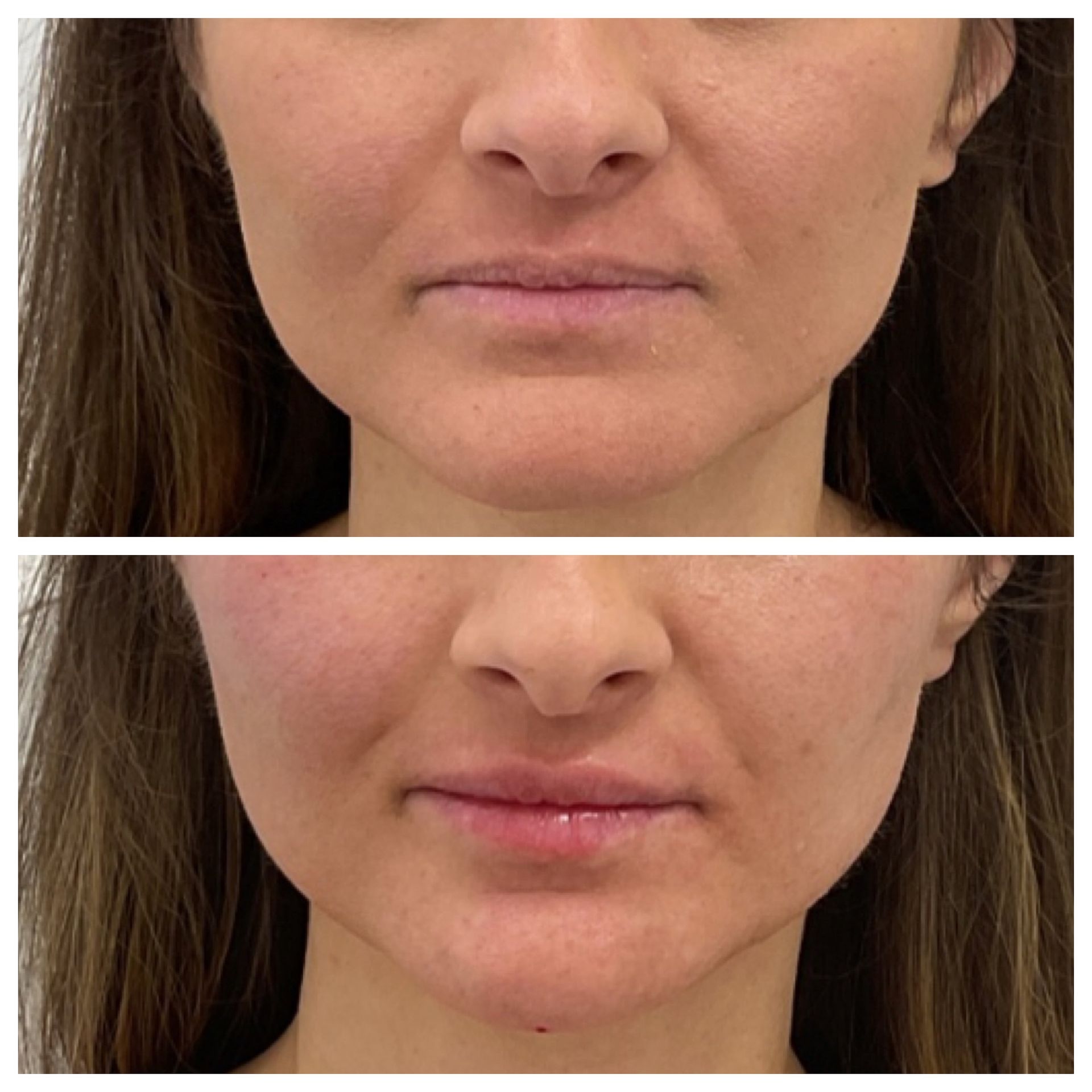 Lip flip Botox in South Windsor | IV Lounge CT