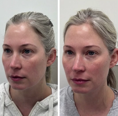 Before and after an RF Microneedling session under the eyes