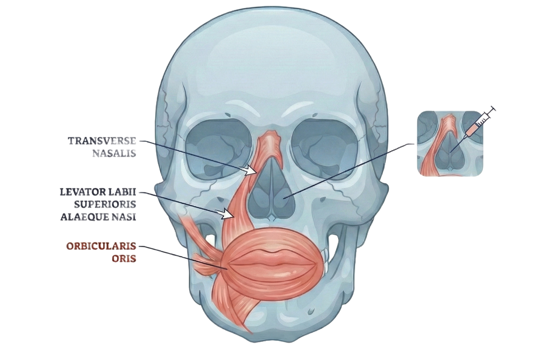 Illustration of lower lip lines botox treatment