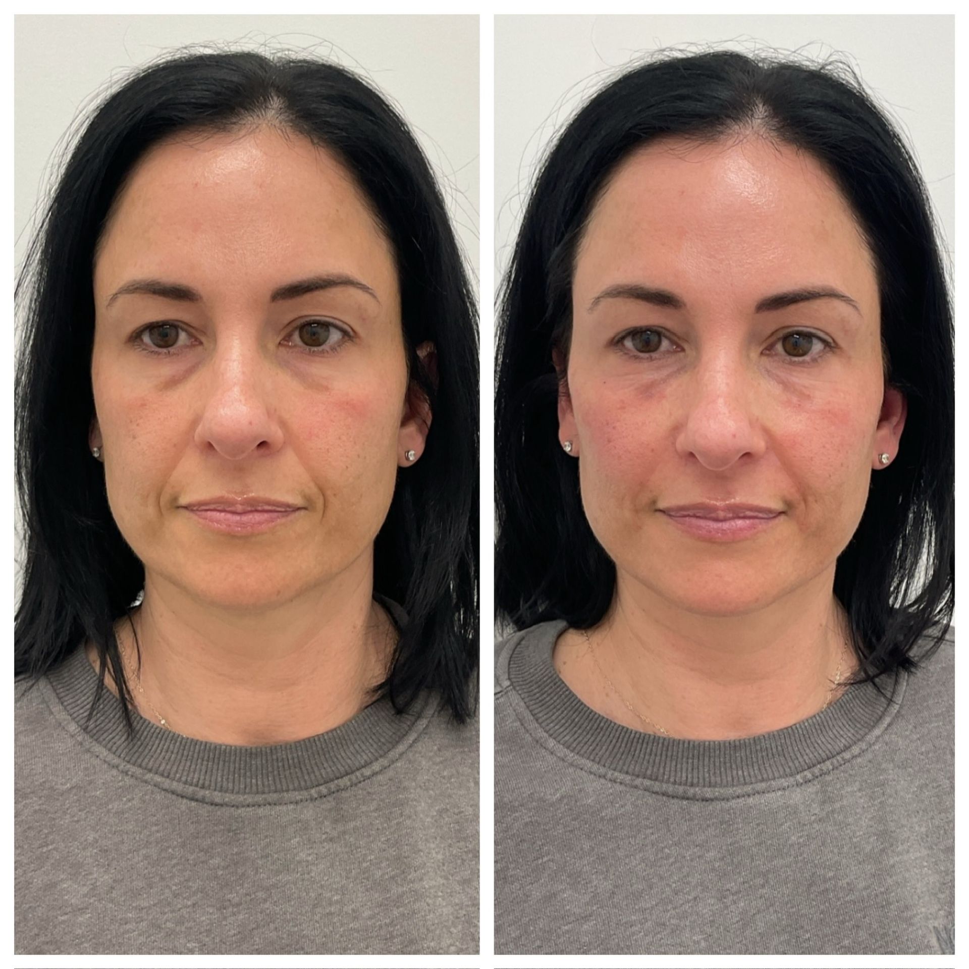 A before and after photo of a woman 's face.
