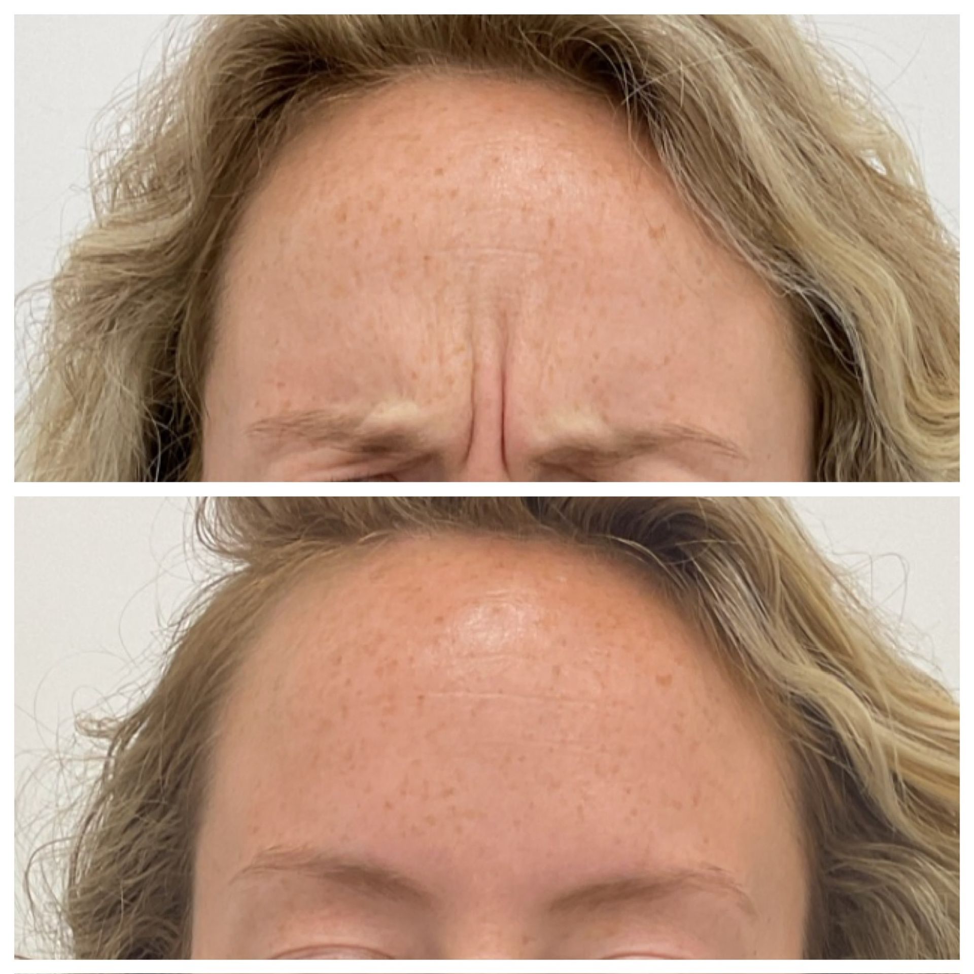 A before and after photo of a woman 's forehead with wrinkles.