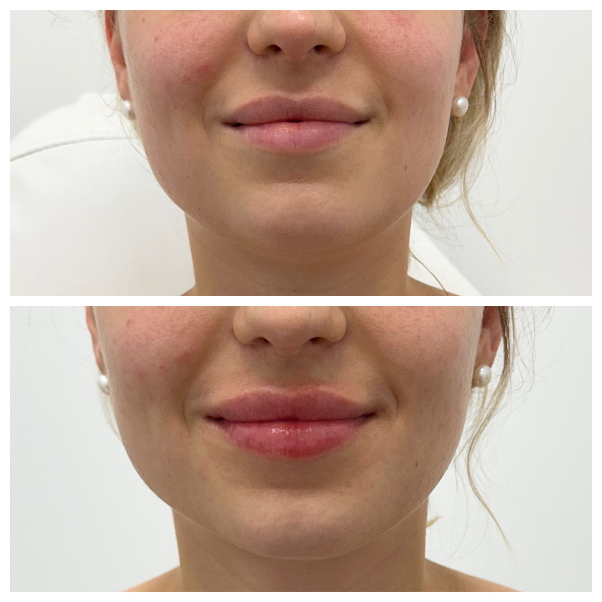 A before and after photo of a woman 's lips.