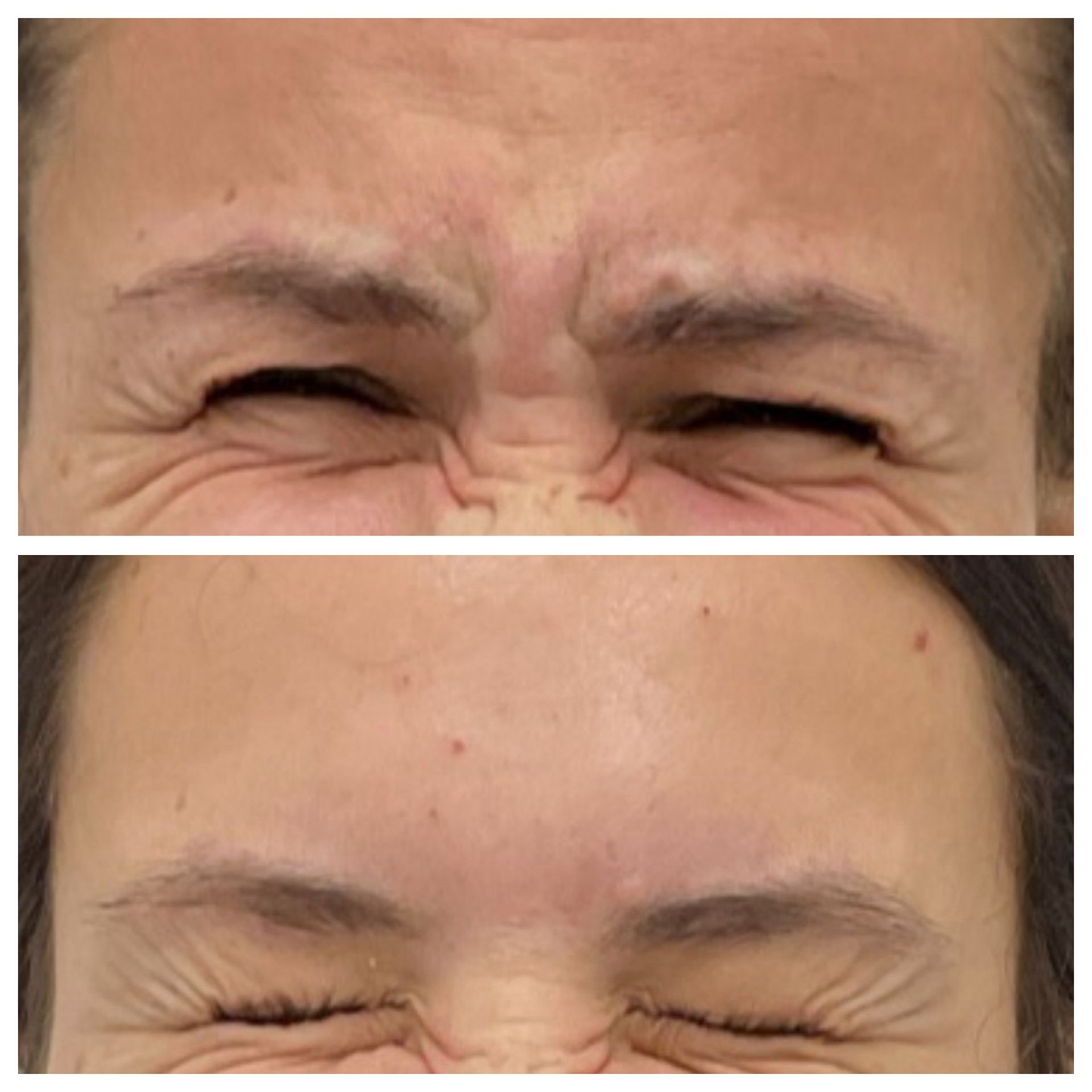 A before and after photo of a woman 's forehead with her eyes closed.