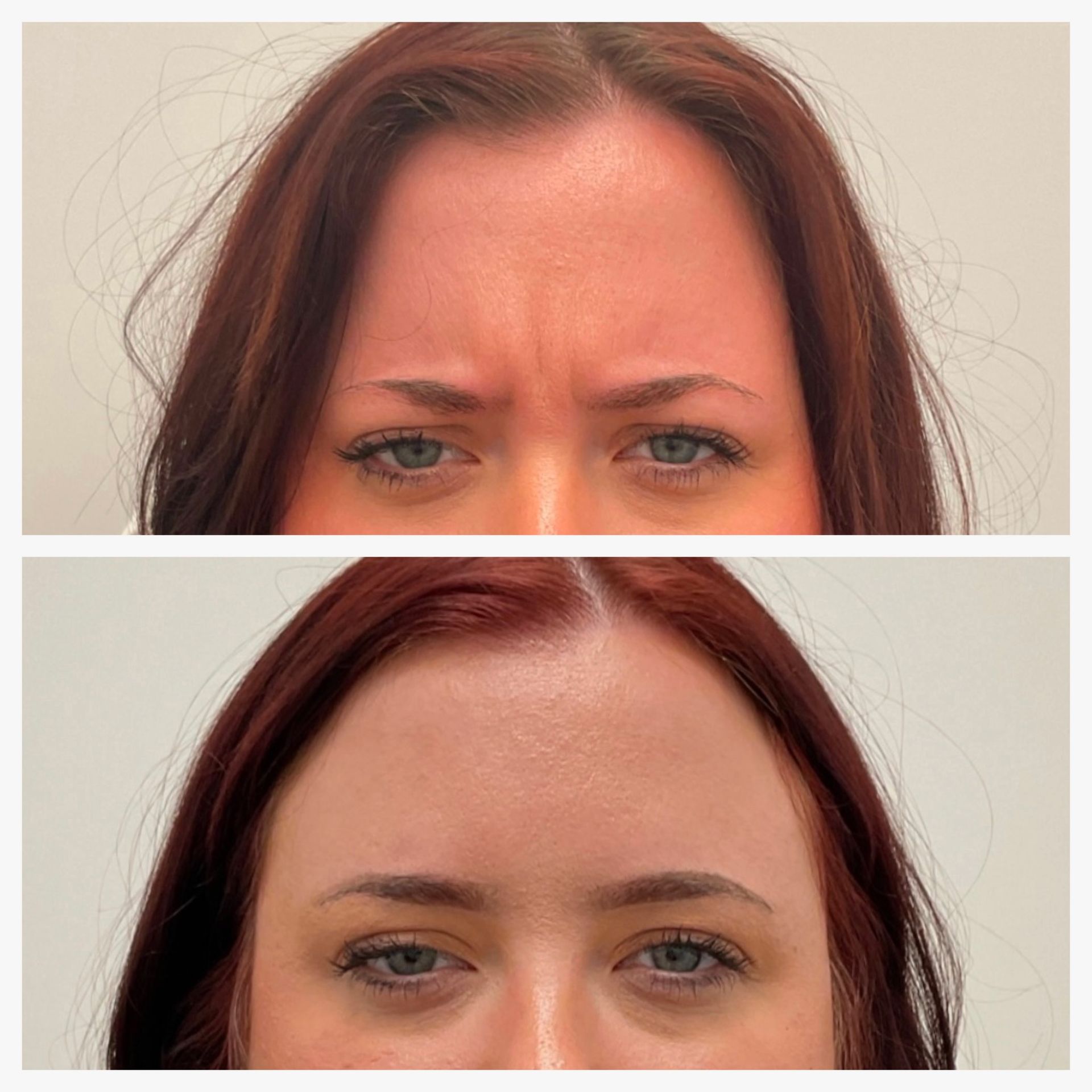 A before and after photo of a woman 's forehead.