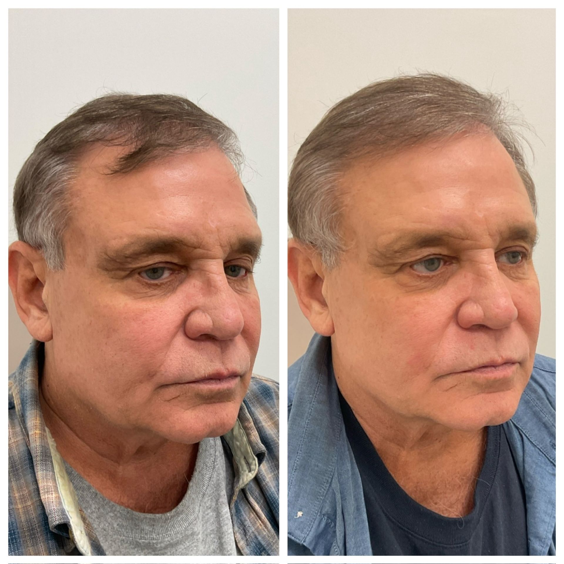 Men before and after of Brotox (masculine botox)
