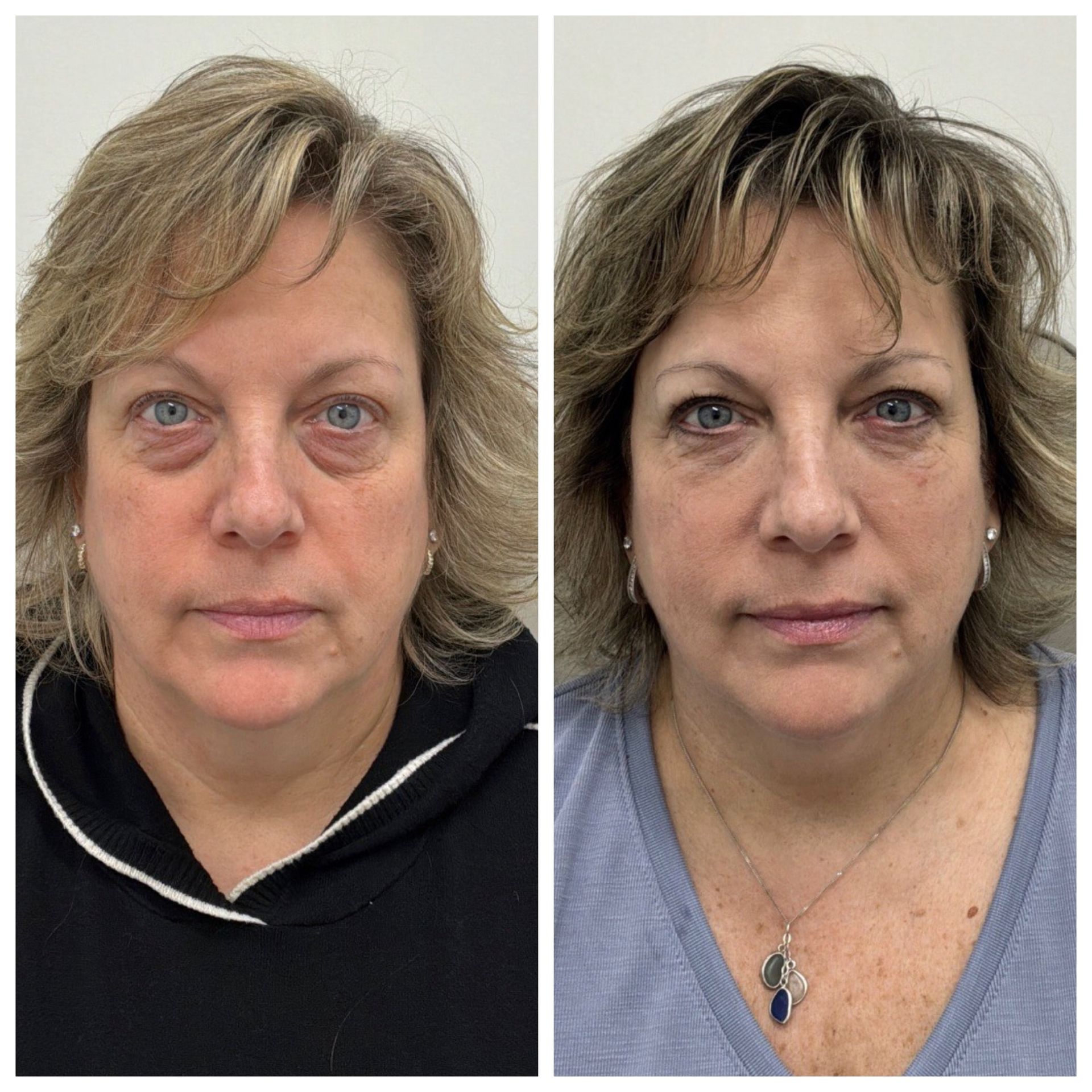 Woman receiving Under-Eye Filler Results in CT