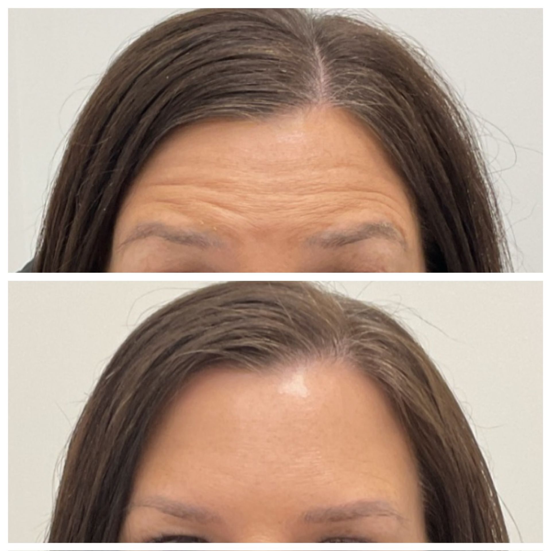 A before and after photo of a woman 's forehead.