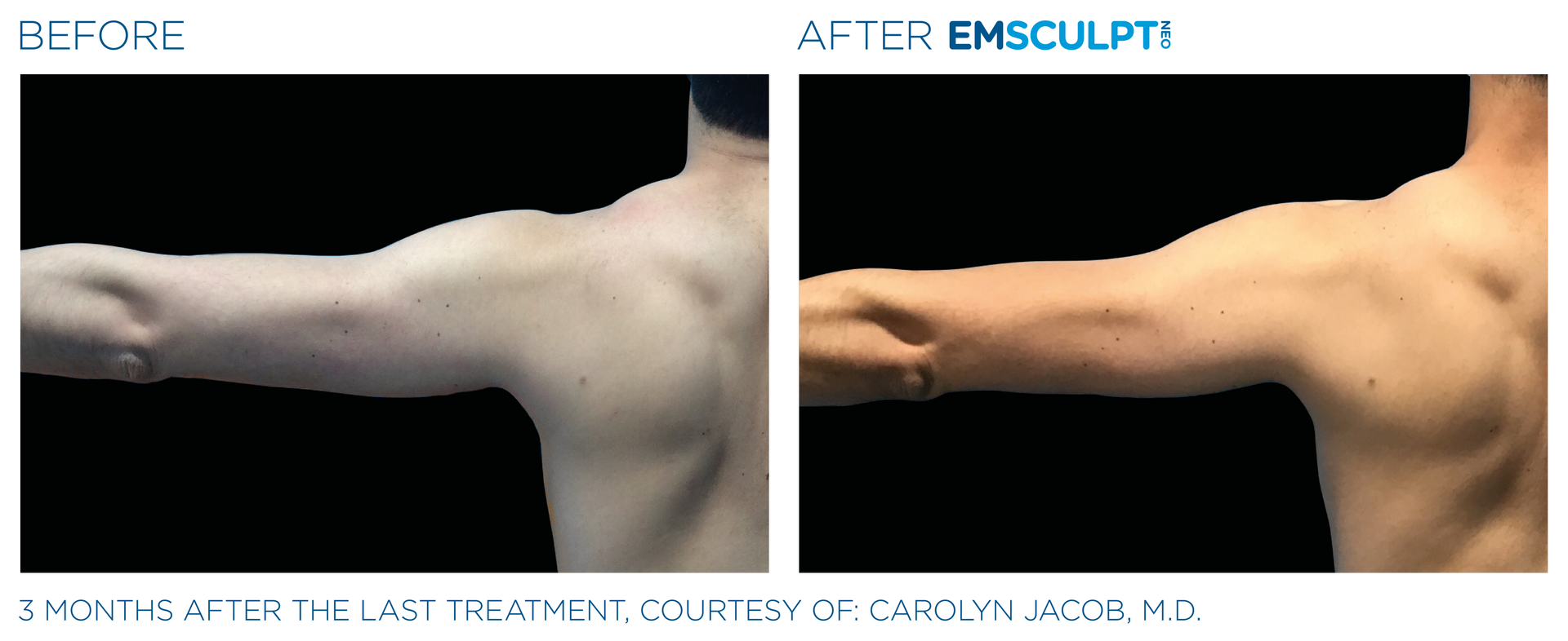 Before-and-after split image of an arm and shoulder, showing reduced fat after Emsculpt treatment.
