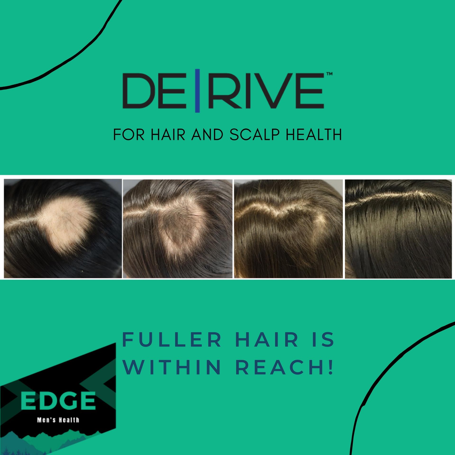 Before and after hair growth photos; product advertisement: De|Rive for hair & scalp health.