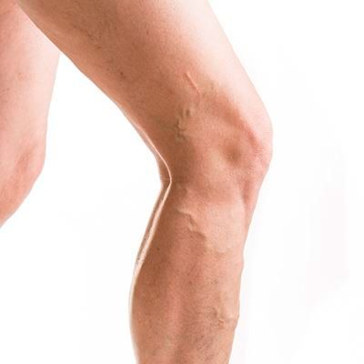 Krampfadern