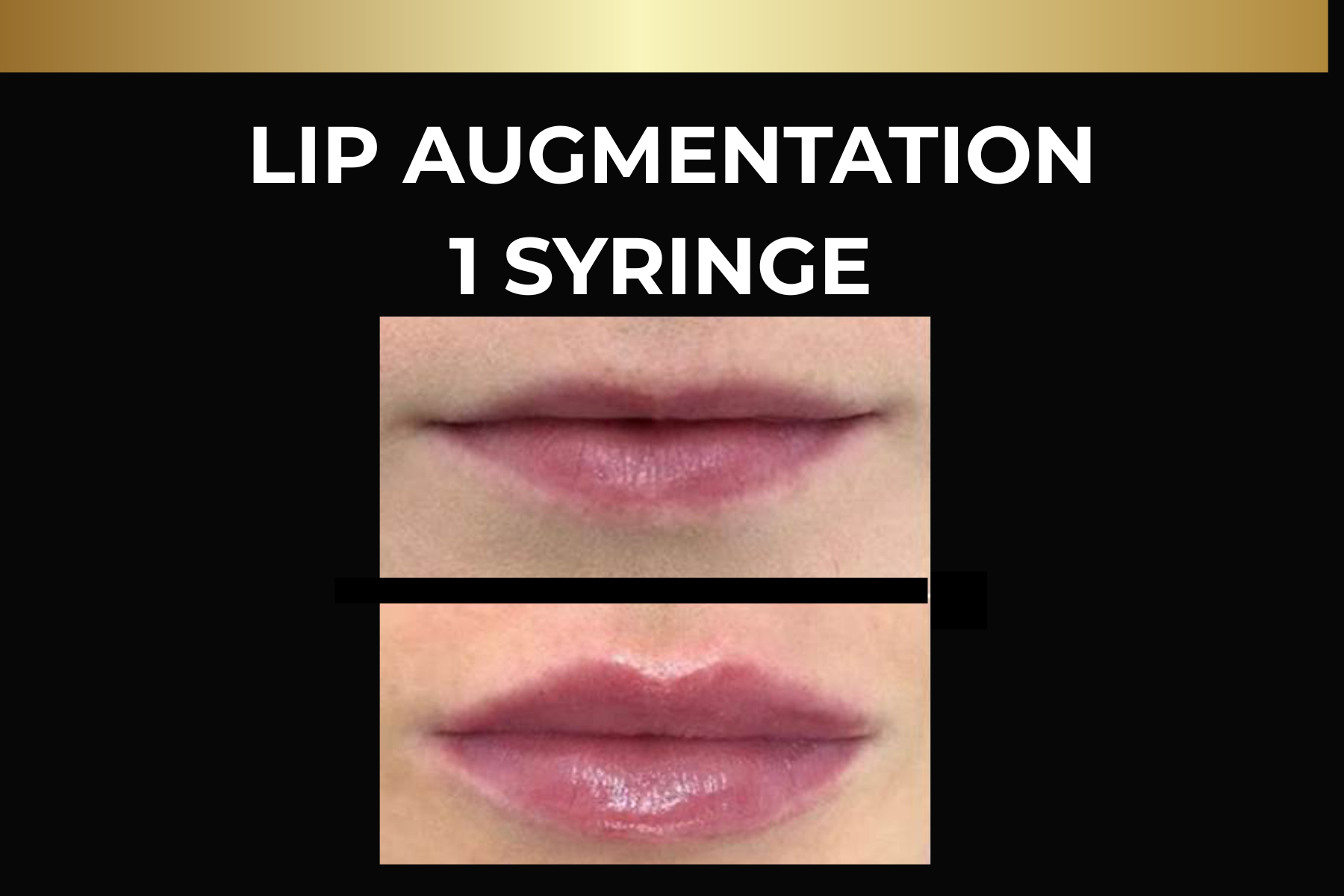 Microneedling skin pen treatment before-and-after facial closeups for Toskani Proage + NCPR, 1 treatment