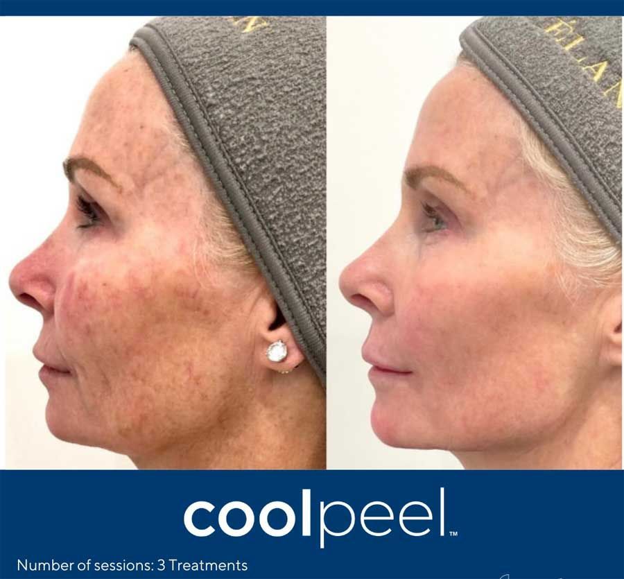 Cool Peel Tetra Pro CO2 Resurfacing Laser Results