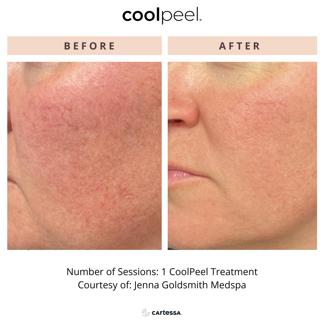 CoolPeel before-and-after close-up of facial skin showing reduced redness and smoother texture