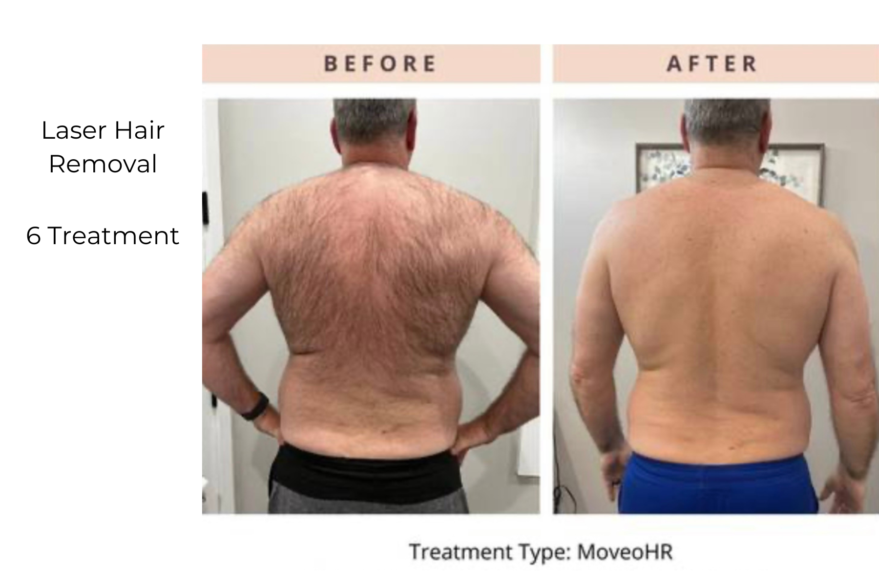 Before-and-after back view showing reduced back hair after 6 laser hair removal treatments.