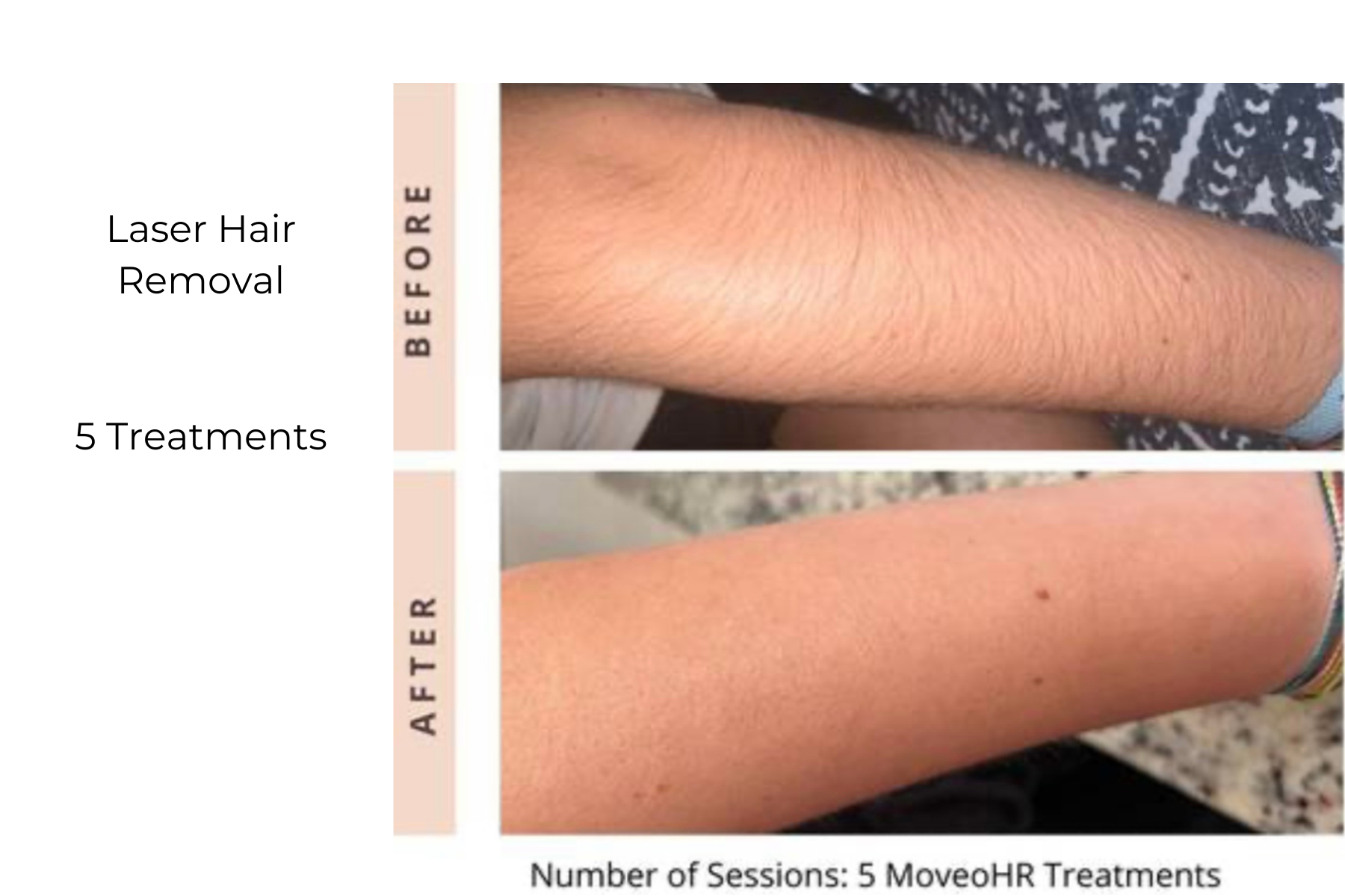 Before-and-after arm photos showing hair reduction after 5 laser hair removal treatments
