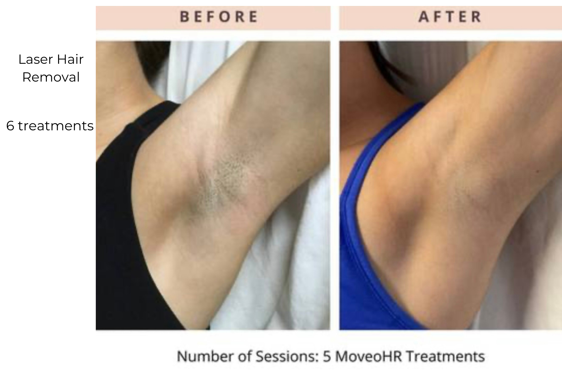 Before-and-after underarm laser hair removal, showing reduced hair after 5 sessions.