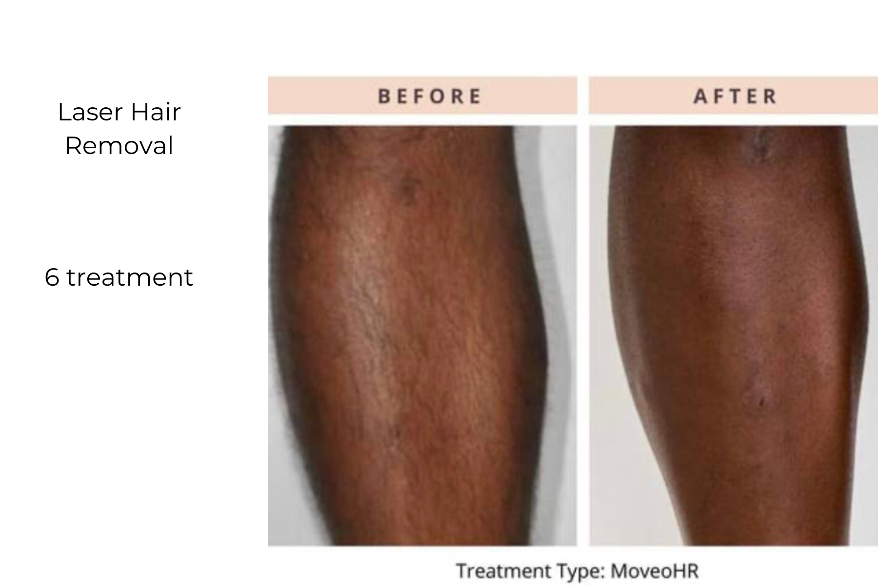 Before-and-after close-up of a leg showing reduced hair after 6 laser hair removal treatments.