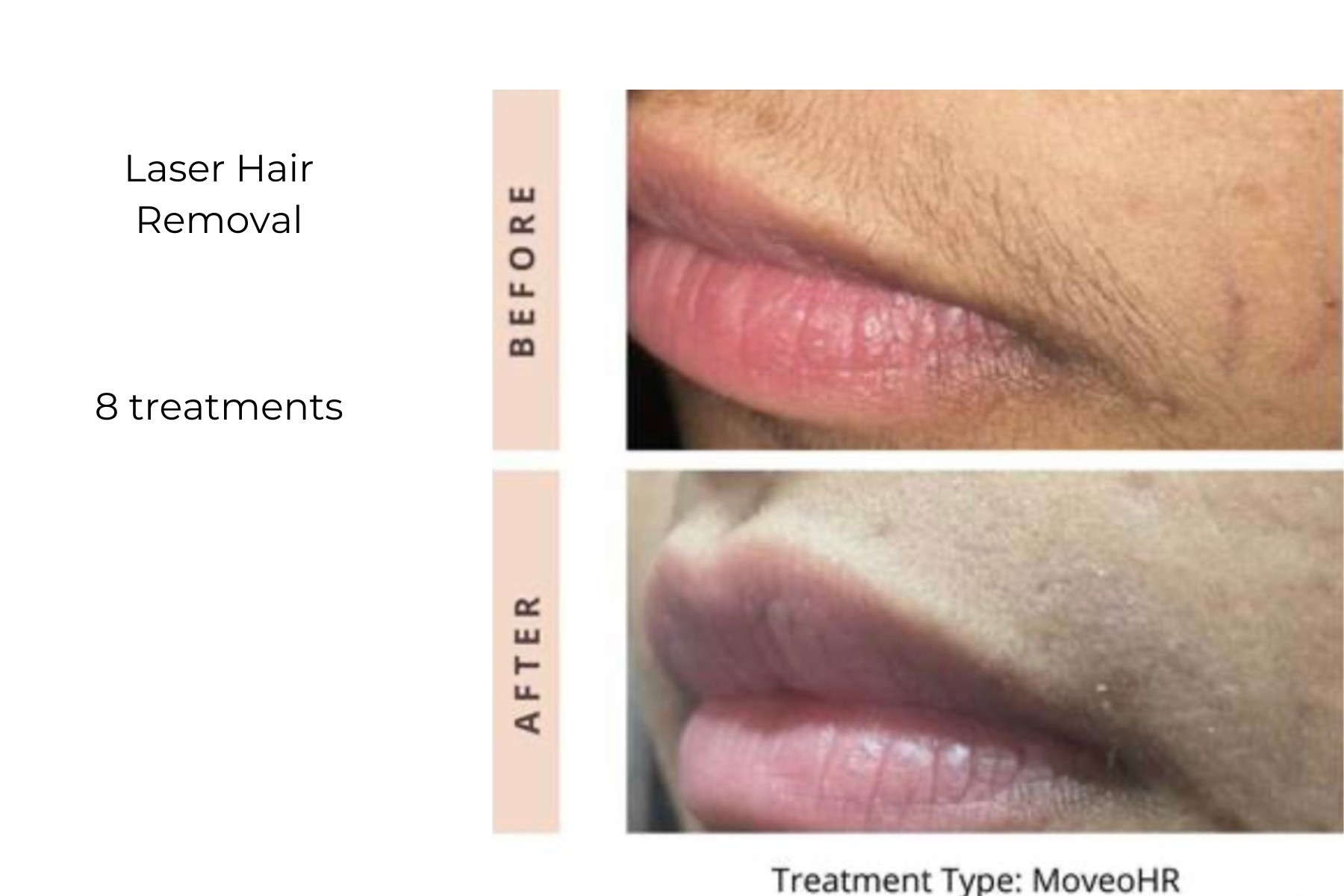 Before-and-after close-up of lips showing laser hair removal results, with “Before” and “After” labels.