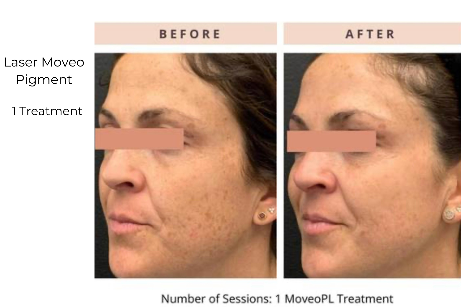 Before-and-after side-by-side face photos showing reduced laser-induced pigment after one treatment.