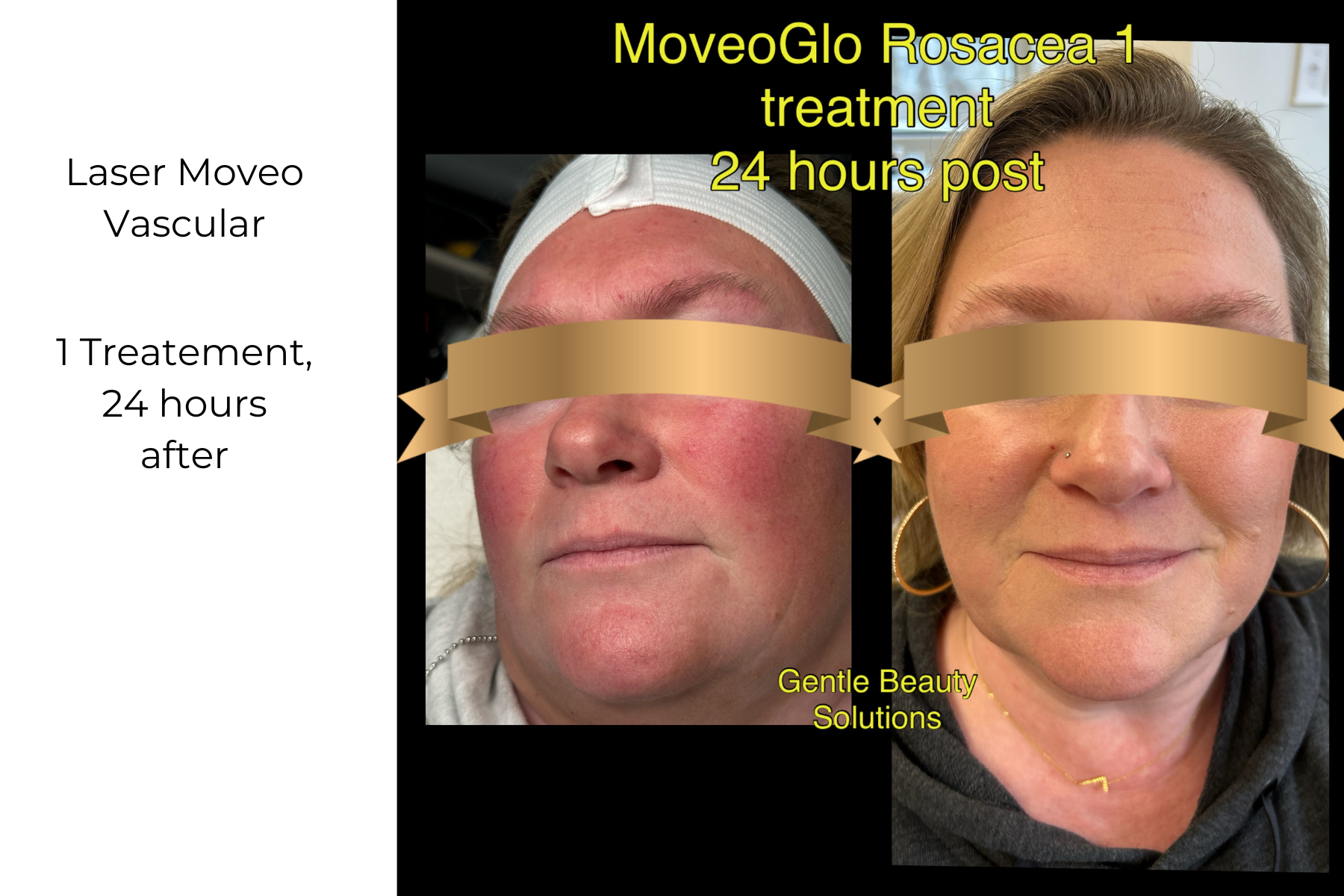 Before-and-after facial treatment photo collage with two close-up portraits and overlaid text showing 24-hour results.