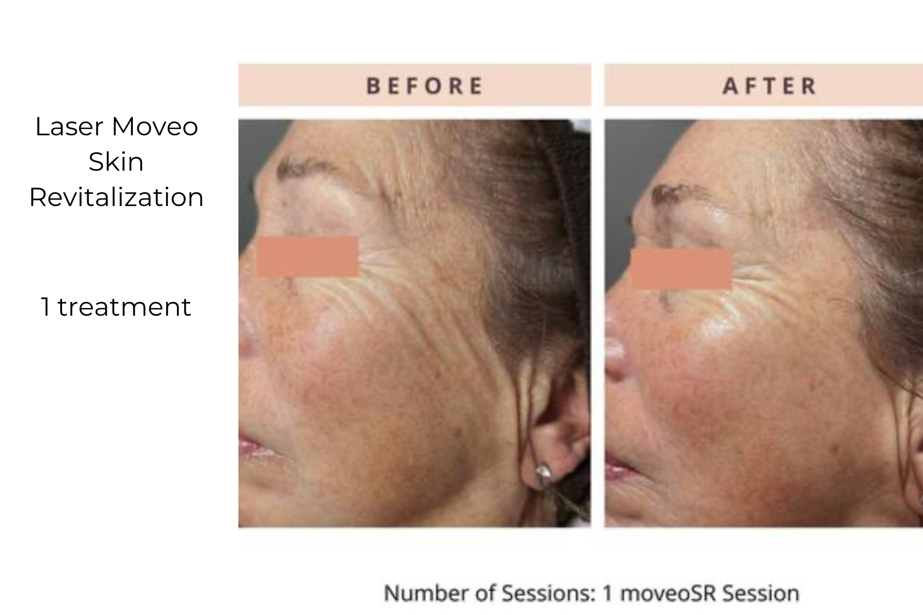 Before-and-after side profile of a facial skin treatment showing reduced wrinkles and smoother skin after one session