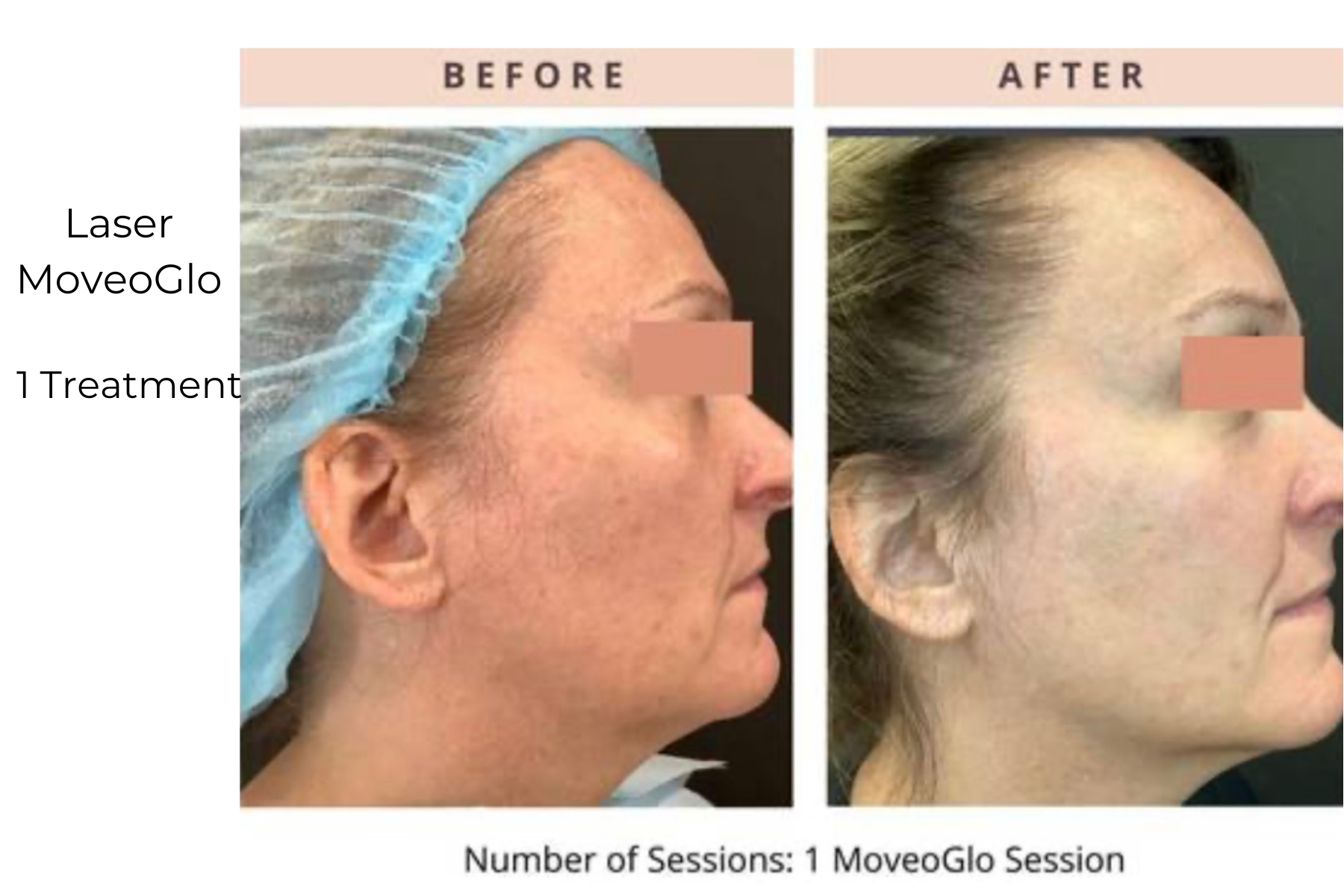 Before-and-after profile photos showing facial skin improvement after one Laser MoveGlo treatment.