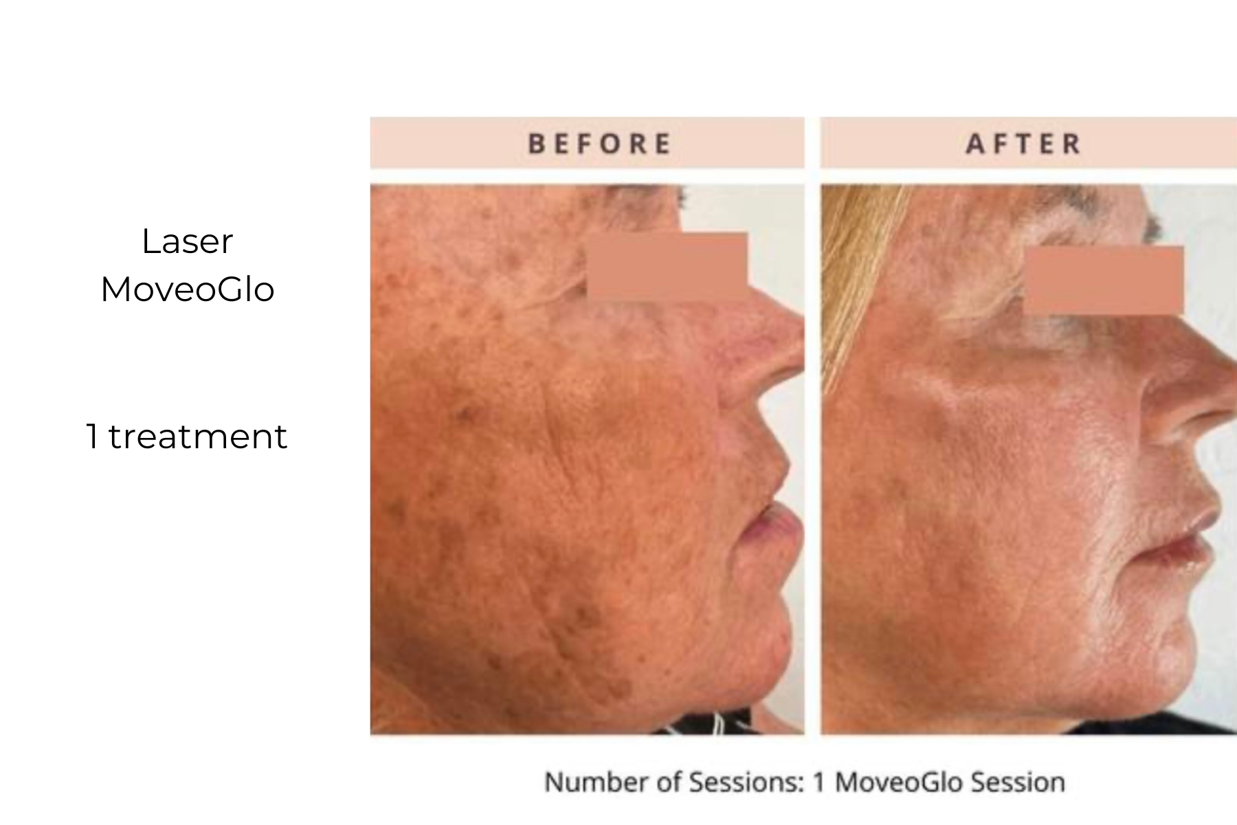 Before-and-after side profiles showing reduced facial wrinkles after 1 Laser MovaCo1 treatment
