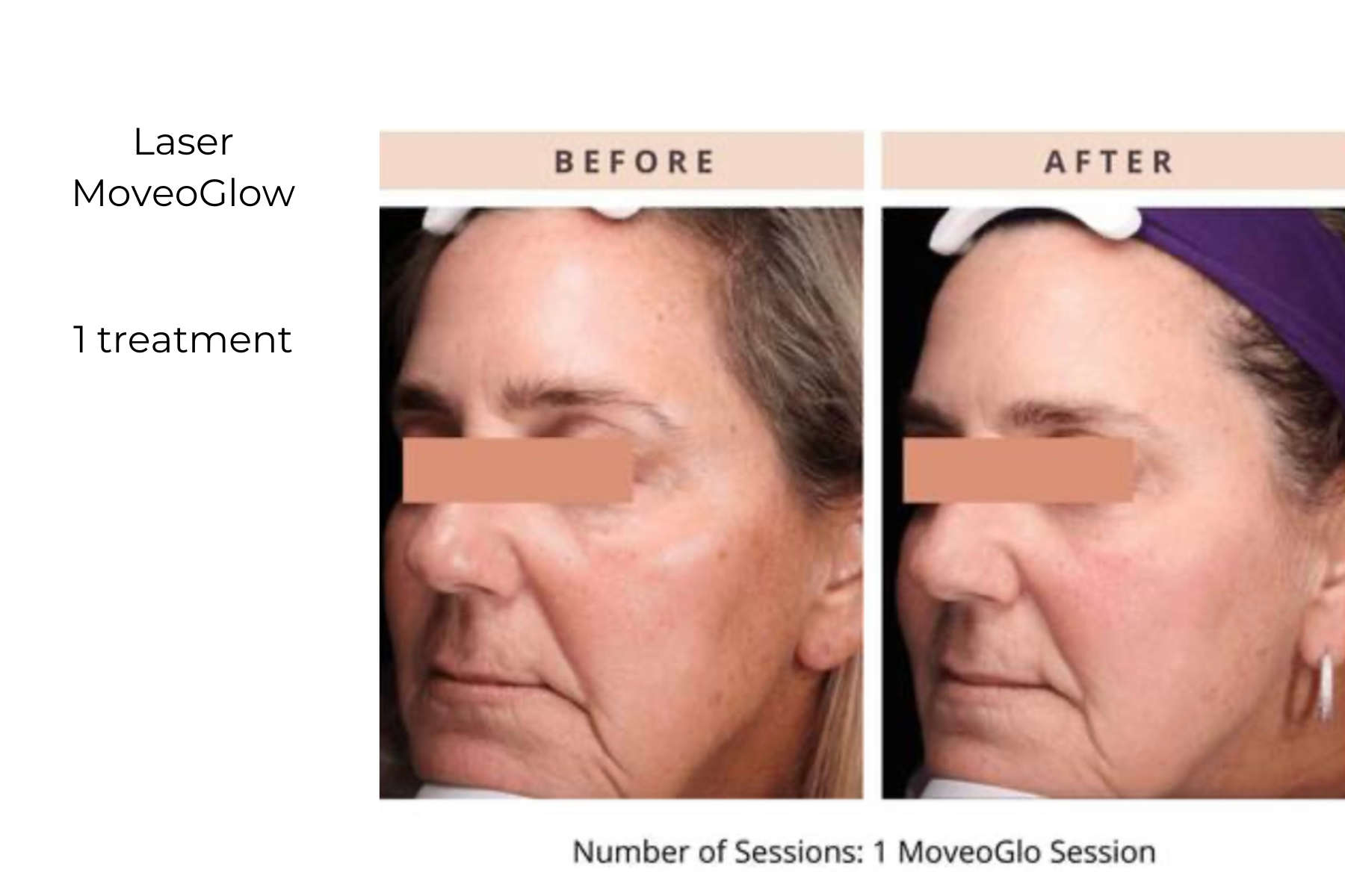 Before-and-after facial treatment photos showing reduced wrinkles and smoother skin after one session