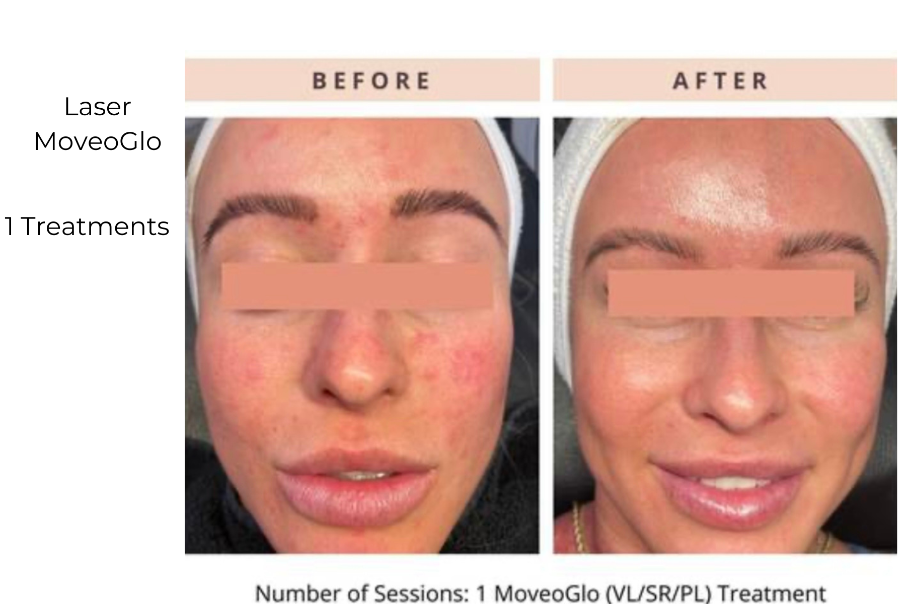 Before-and-after facial laser treatment photos showing reduced redness and smoother skin after one session
