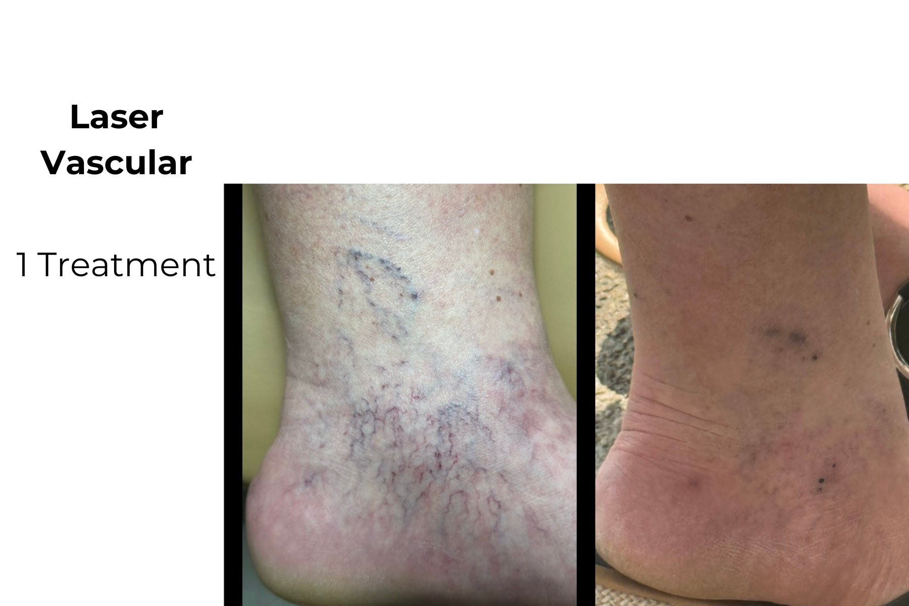 Laser vascular treatment results showing a leg before and after one session
