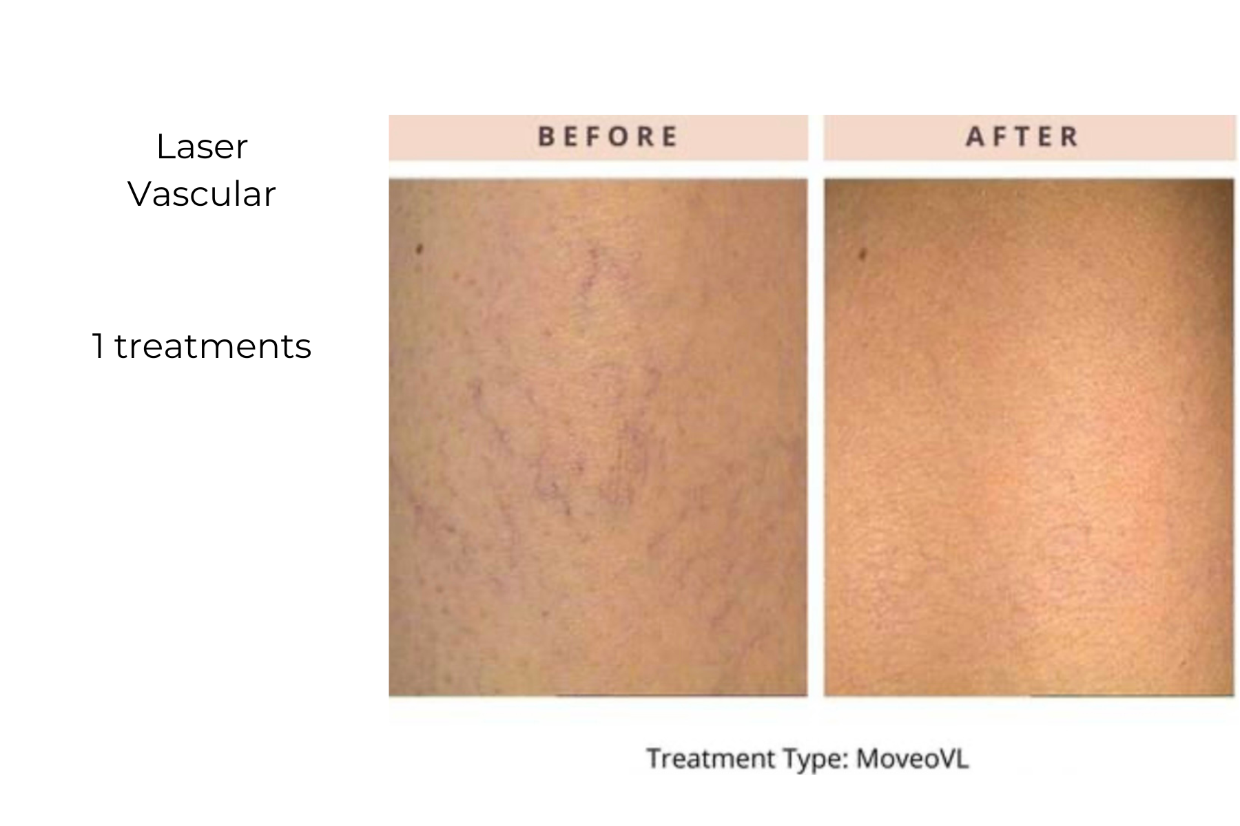 Before-and-after skin treatment photos showing reduced facial veins and redness after laser vascular treatment