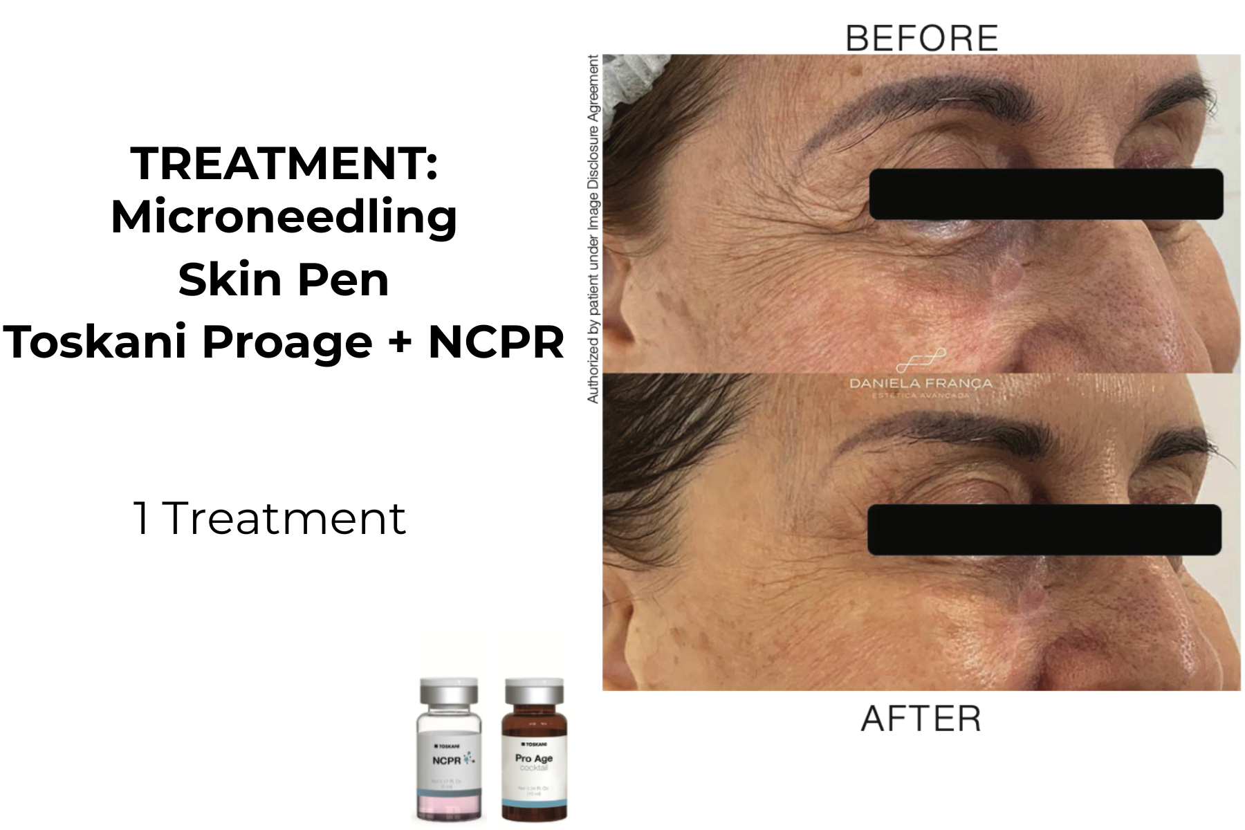 Microneedling skin pen treatment before-and-after facial closeups for Toskani Proage + NCPR, 1 treatment