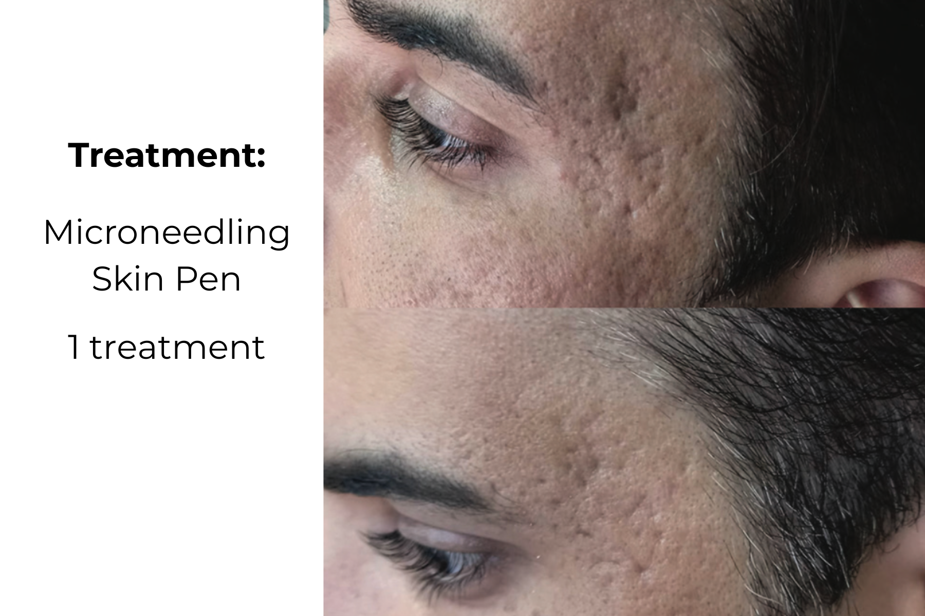 Before-and-after facial close-up showing acne scars treated with microneedling skin pen, labeled “1 treatment.”