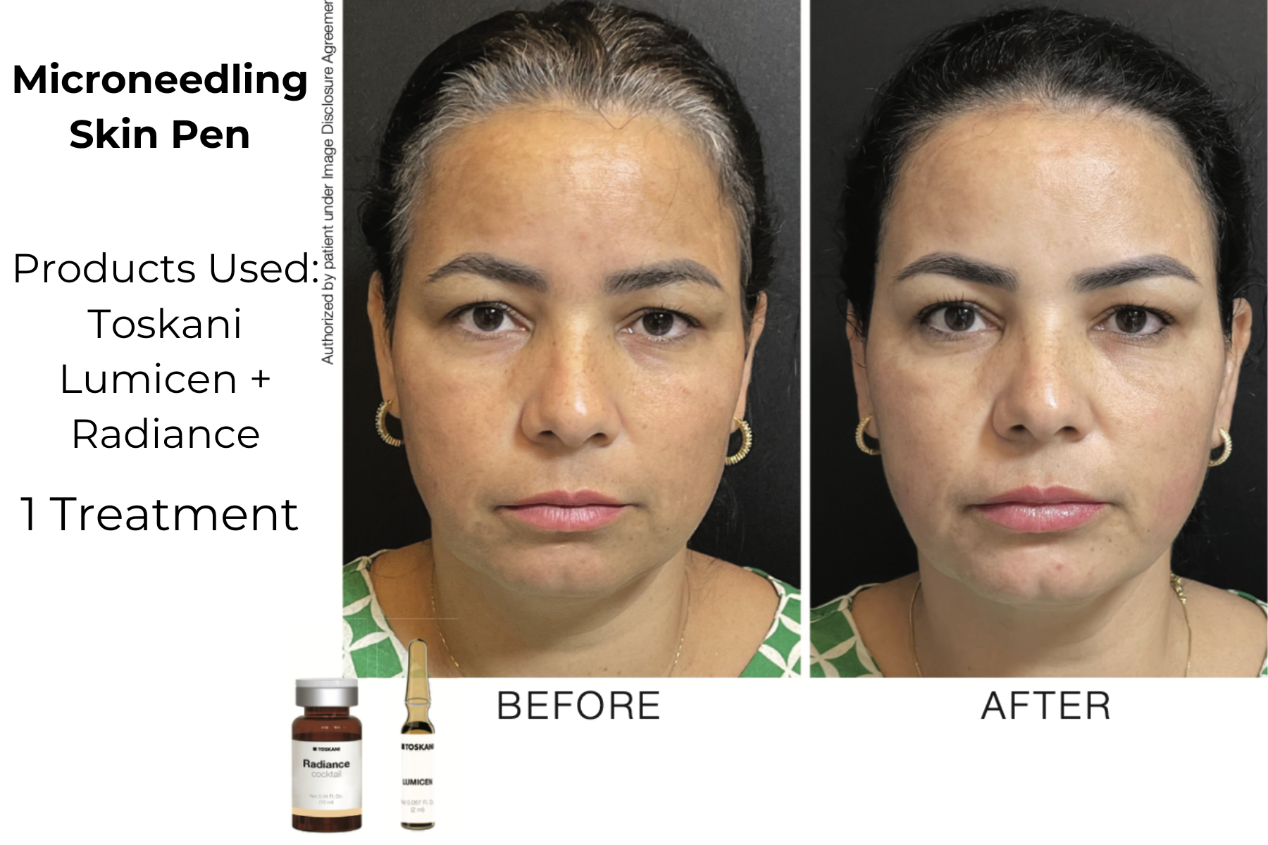 Before-and-after facial skincare results for microneedling skin pen treatment, with product bottles shown.
