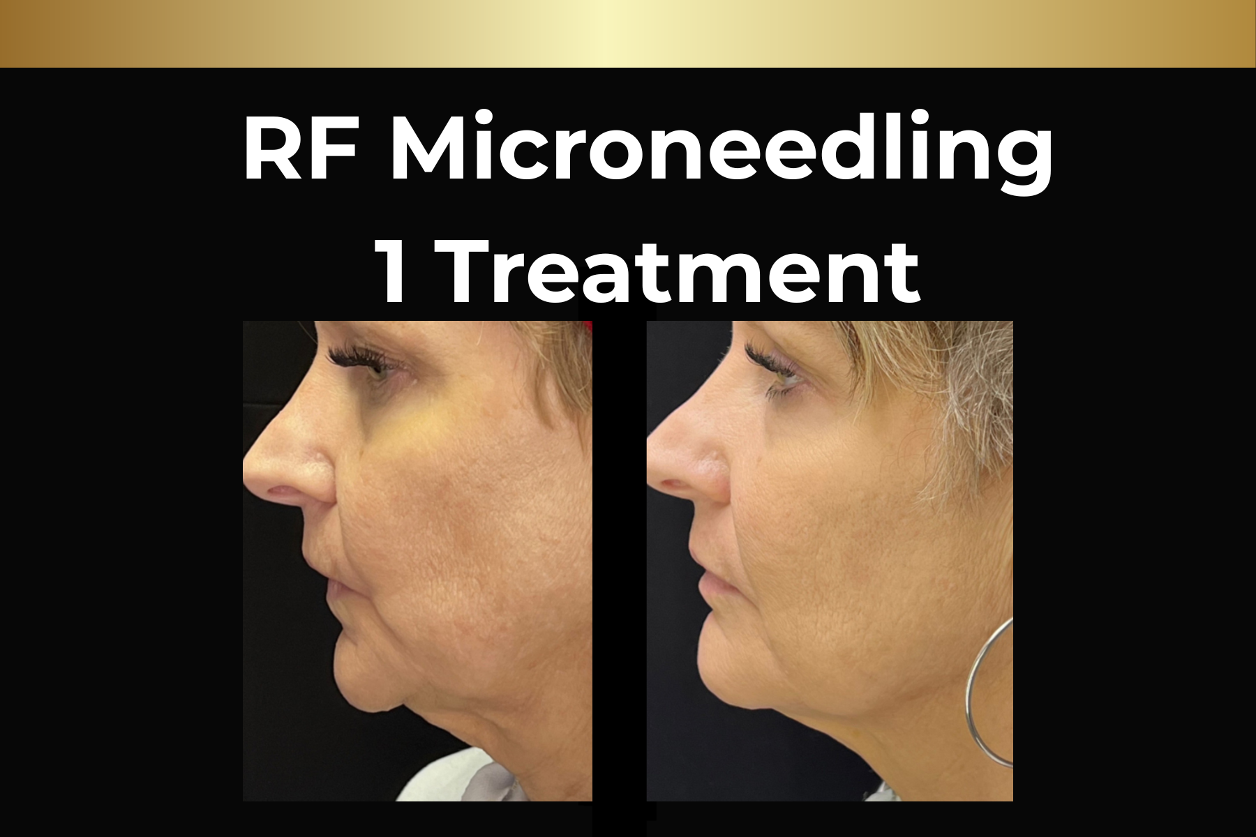 Before-and-after facial close-up showing acne scars treated with microneedling skin pen, labeled “1 treatment.”