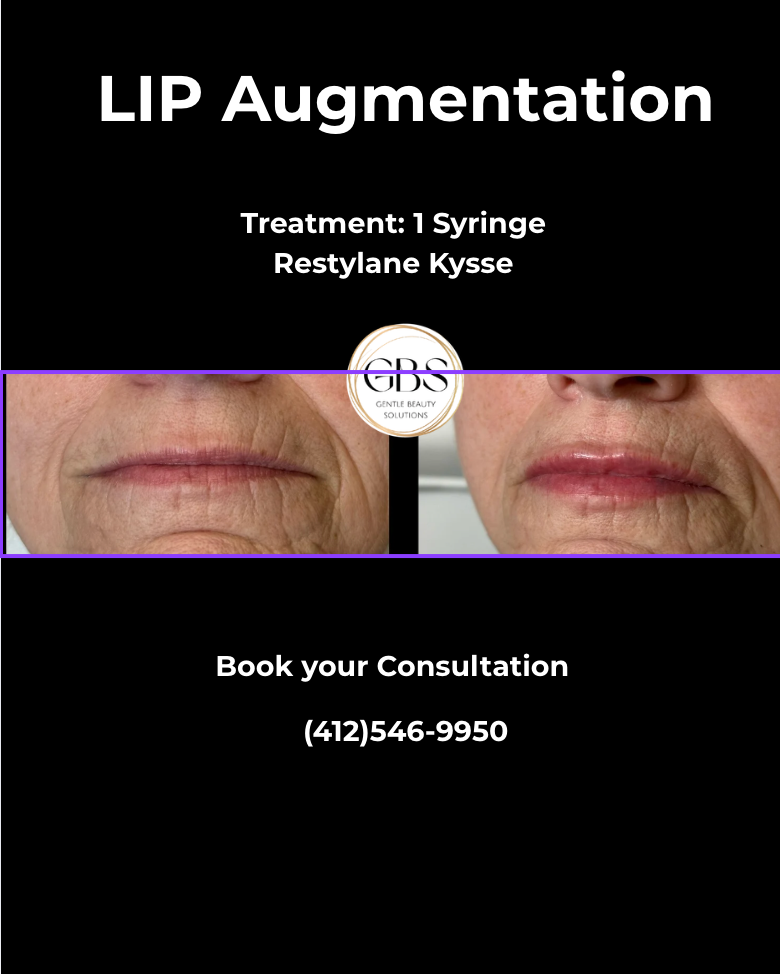 LIP Augmentation ad with before-and-after lips