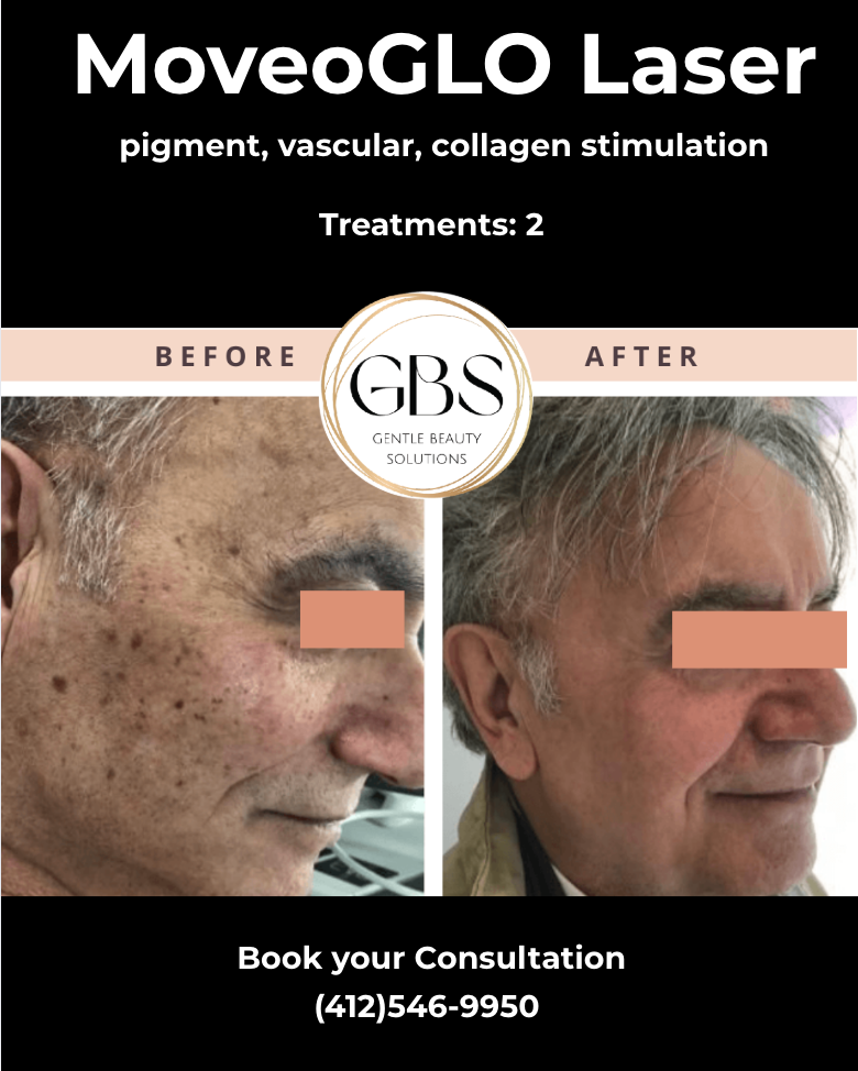 Before-and-after faces showing skin improvement after MoveoGLO laser treatment, with consultation phone number.