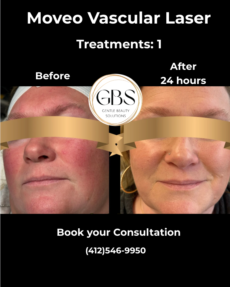 Moveo Vascular Laser ad showing before-and-after facial redness results with consultation phone number