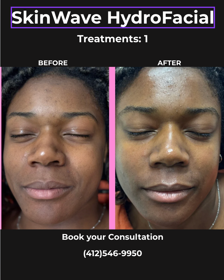 Microneedling skin pen treatment before-and-after facial closeups for Toskani Proage + NCPR, 1 treatment